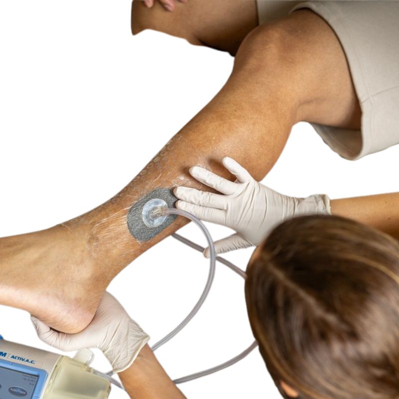 Negative pressure dressing over a pressure ulcer